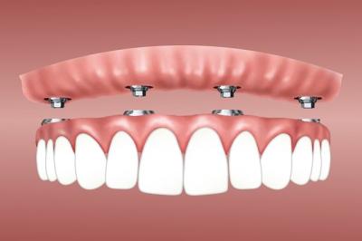 implant dentaire - dentiste enghien